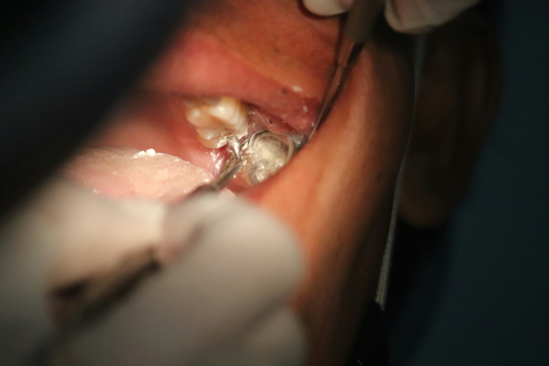 How Biomimetic Fillings Improve Tooth Repair Without Metal