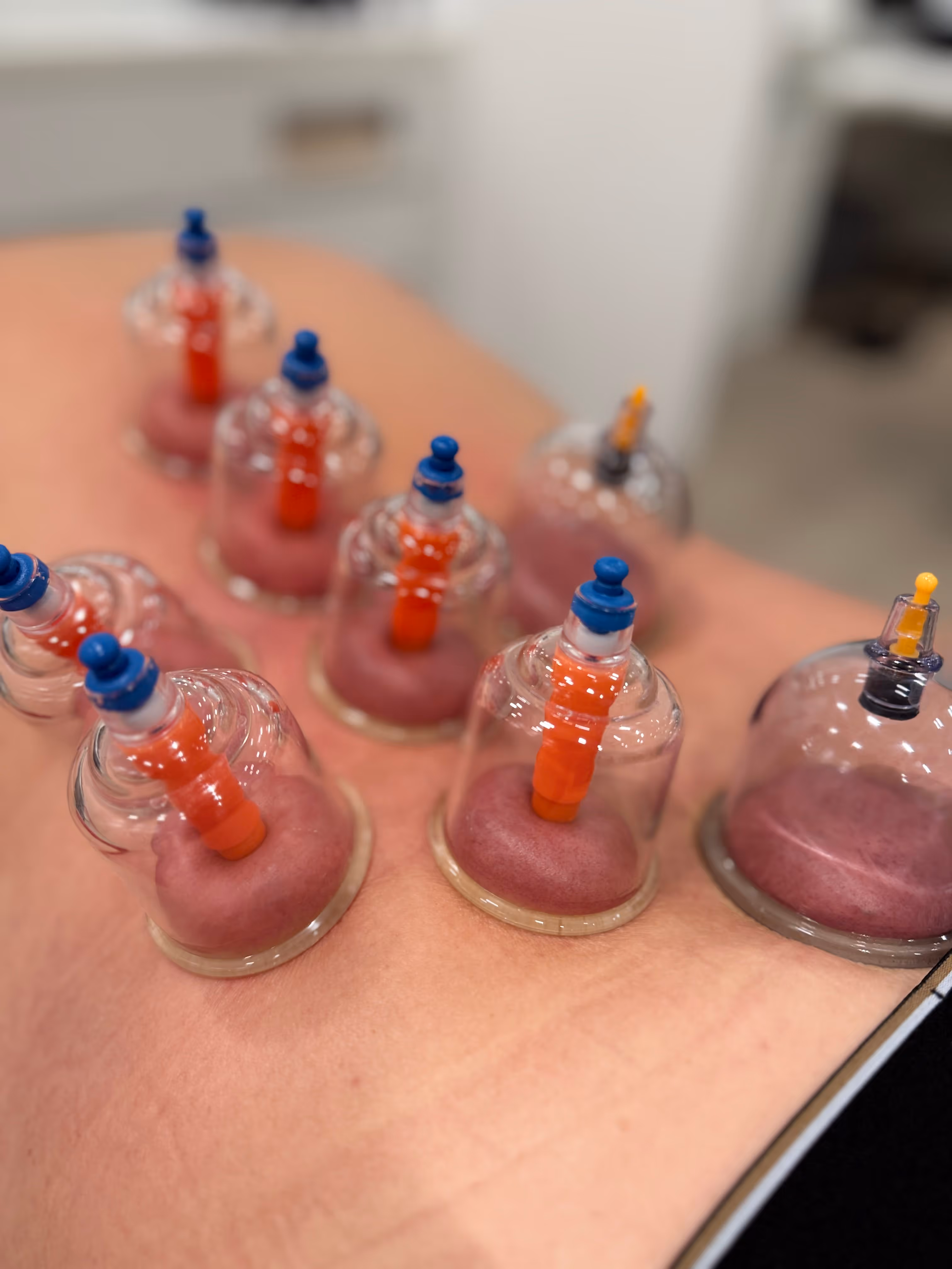 Mehrere Schröpfgläser mit roten Gummiauflagen auf der Haut für Schröpftherapie.