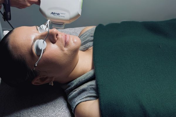 Woman lying down with protective eye shields receiving a laser skin treatment on her face.