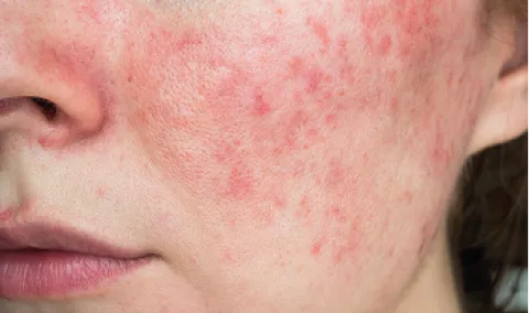 A woman with acne on her face.