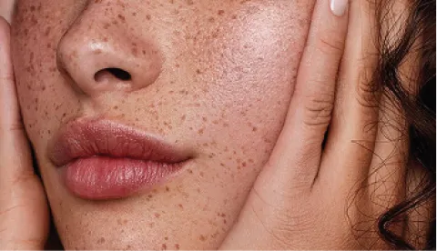 A close up of a woman with freckles on her face.
