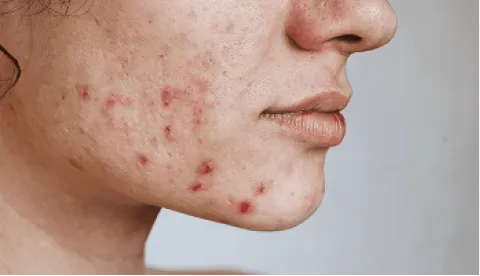 A woman with acne on her face.