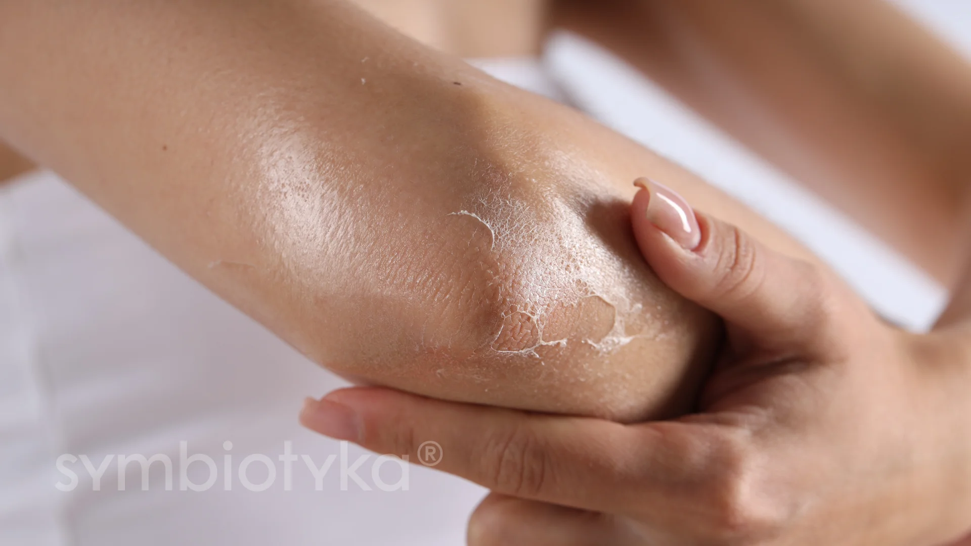 Close-up of a hand holding an elbow with dry, flaky skin.
