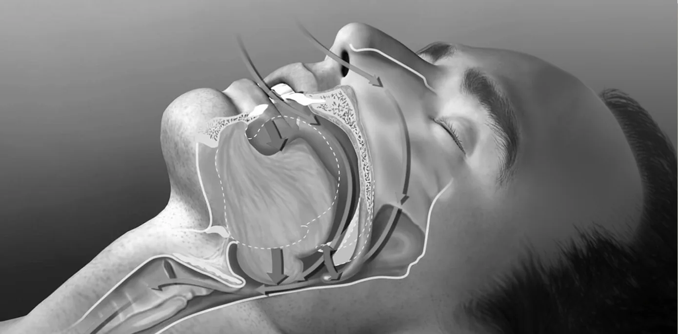 Anatomical illustration of the human airway during sleep, showing how airway collapse and mouth breathing cause snoring