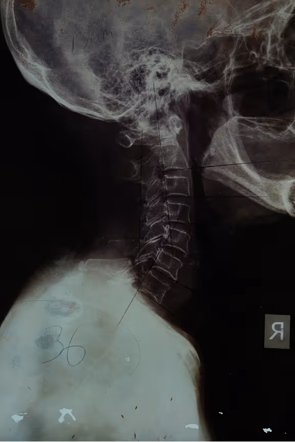 Cervical spine X-ray of an 86-year-old female in Singapore showing almost perfect structural alignment, a healthy natural neck curve, and zero spinal degeneration. Neck Pain Treatment Singapore