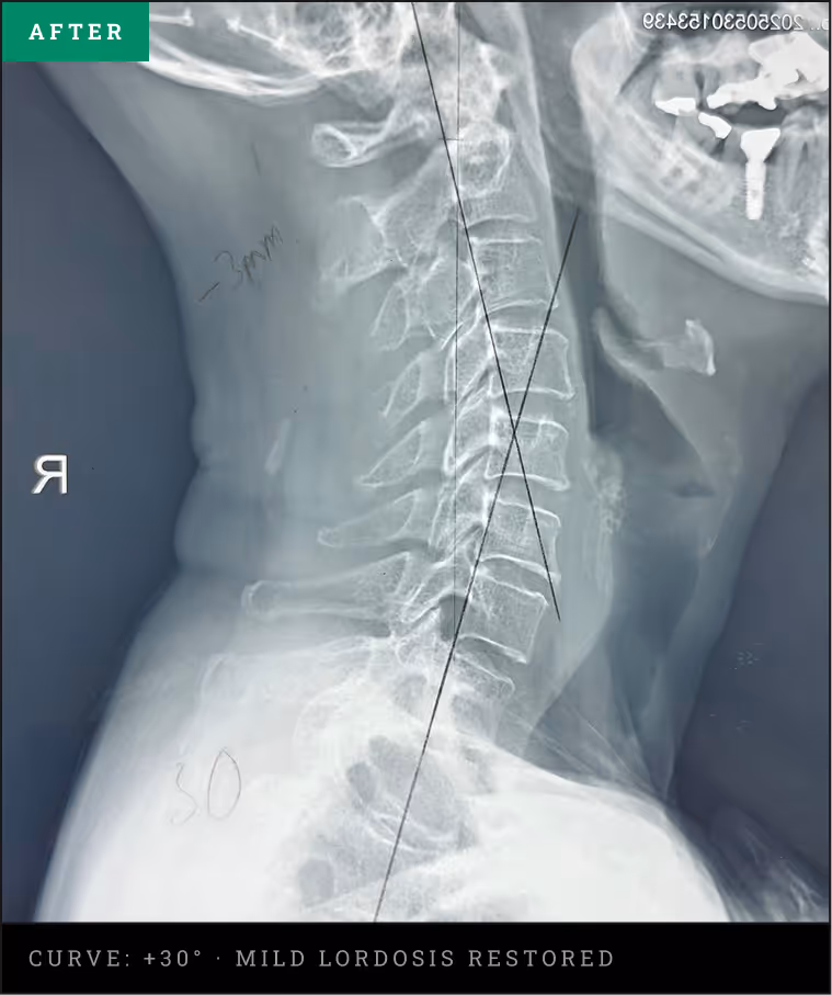 Lateral cervical spine X-ray showing a restored 30-degree normal lordosis curve after R3NEW X protocol treatment