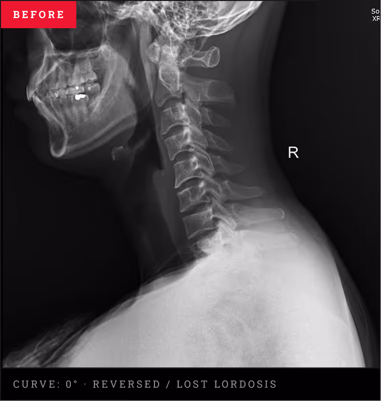 Cervical spinal X-ray demonstrating a completely straight neck and lost lordosis curve from an old sports injury