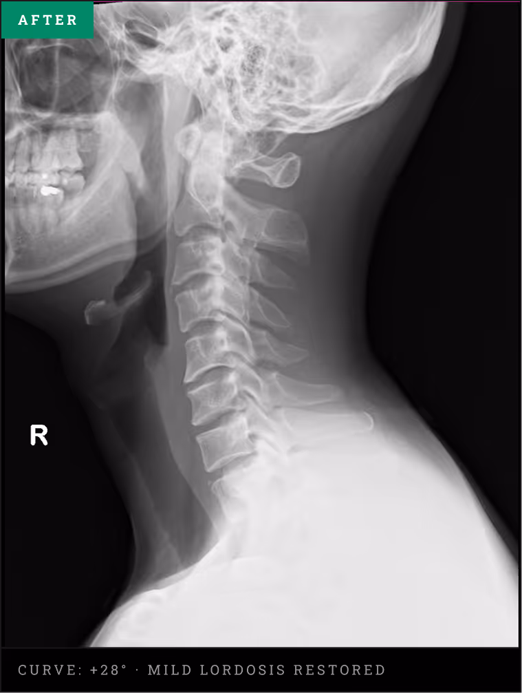Cervical spine X-ray showing a restored 28-degree healthy neck curve following advanced structural traction