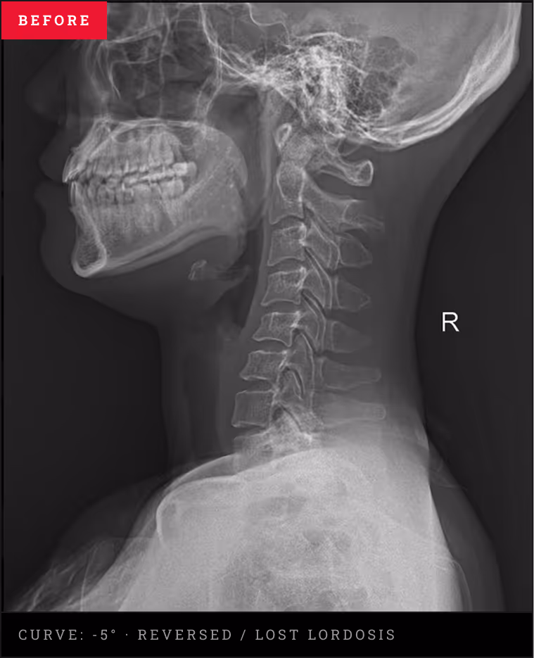 Lateral neck X-ray showing a rare overcorrected spinal presentation with backward head translation and joint strain