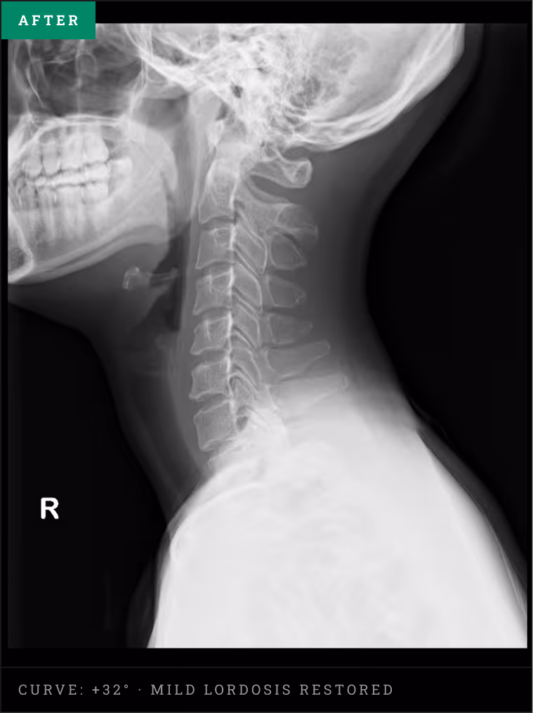 Lateral neck X-ray demonstrating corrected 32-degree cervical lordosis after customised seated traction