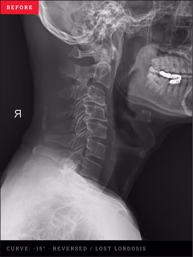 Cervical X-ray showing severe spinal degeneration, bone spurs, thinning discs, and an S-shaped neck profile