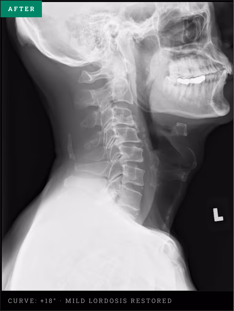 Cervical X-ray showing a corrected mild lordosis curve and improved joint spacing after structural decompression