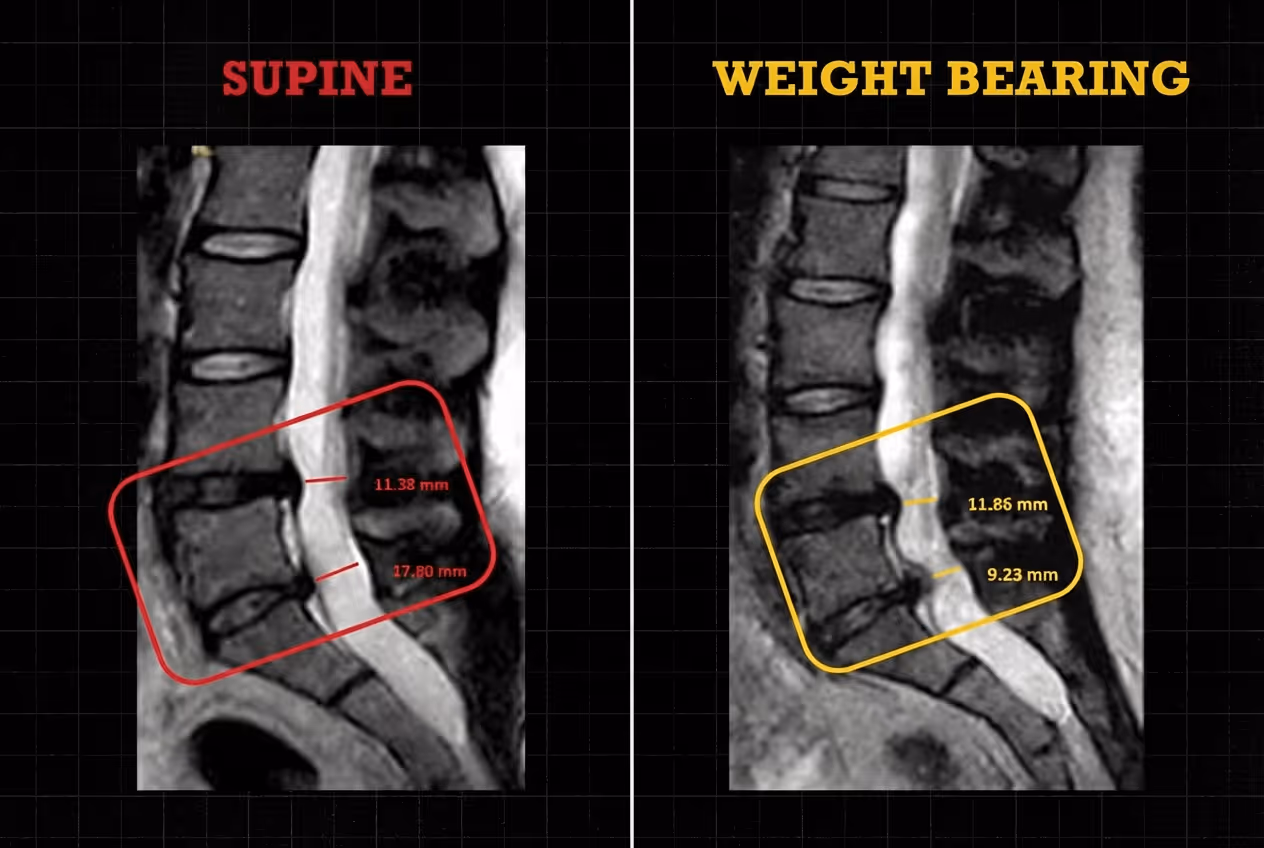 Side-by-side comparison of a lumbar spine MRI showing a clear difference in canal measurements between a lying down supine scan and an upright weight-bearing scan