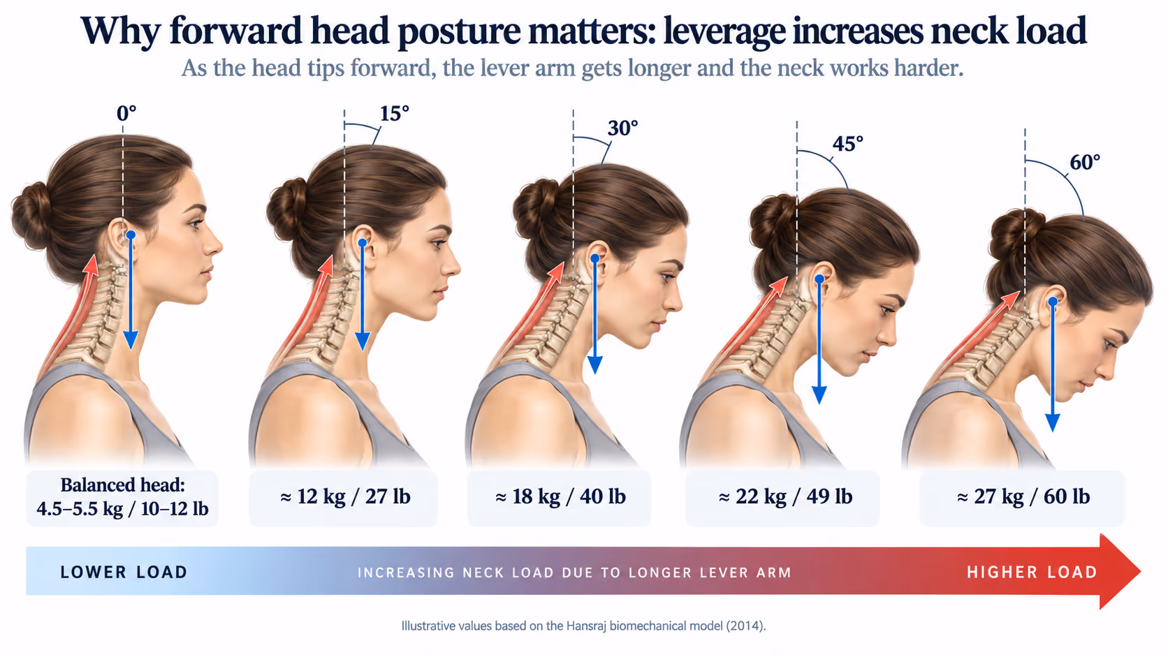 Diagram of how forward head posture increases cervical spine load as the head tilts forward (tech neck)