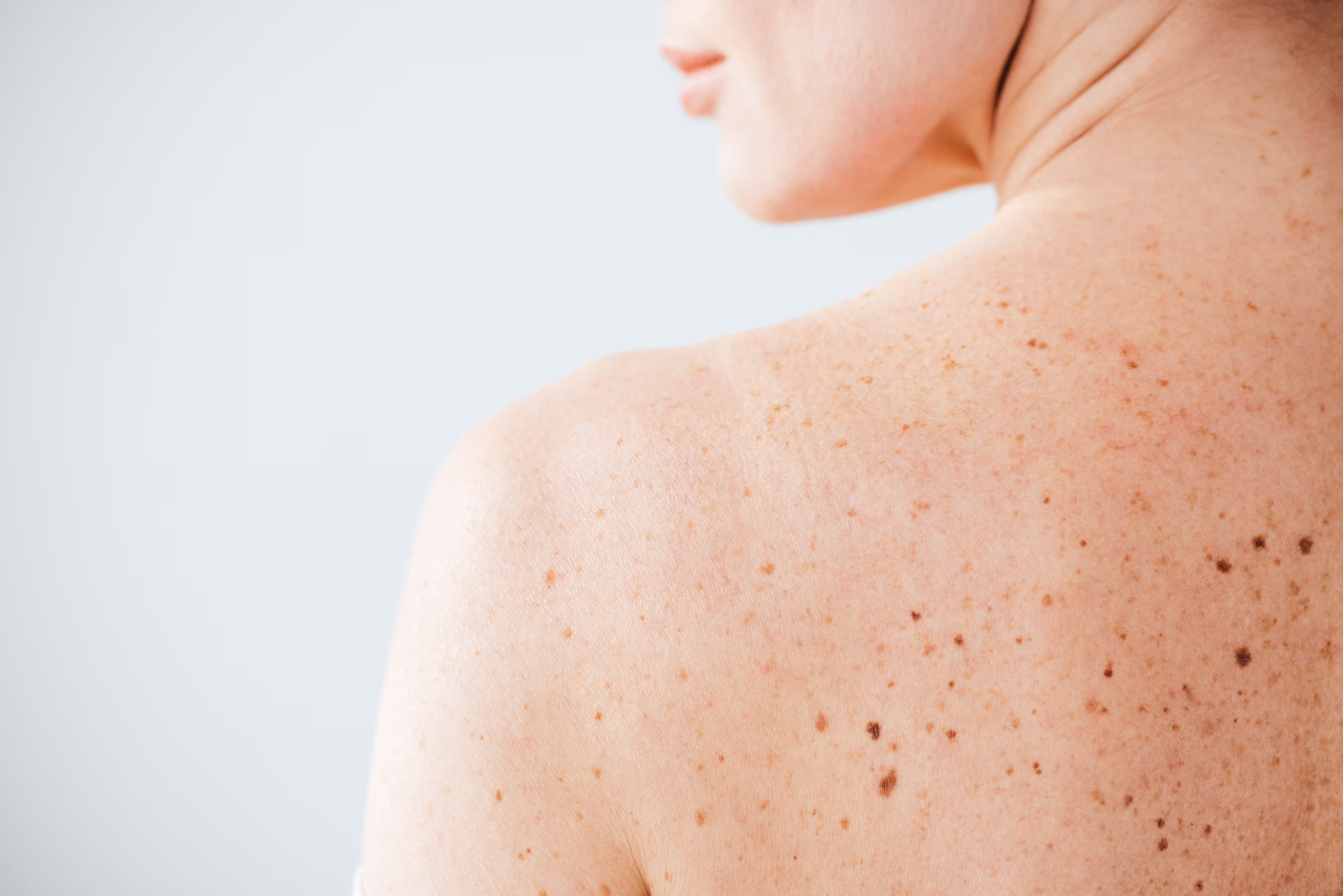 Close-up of person's shoulder and upper back with multiple freckles and moles on light skin.