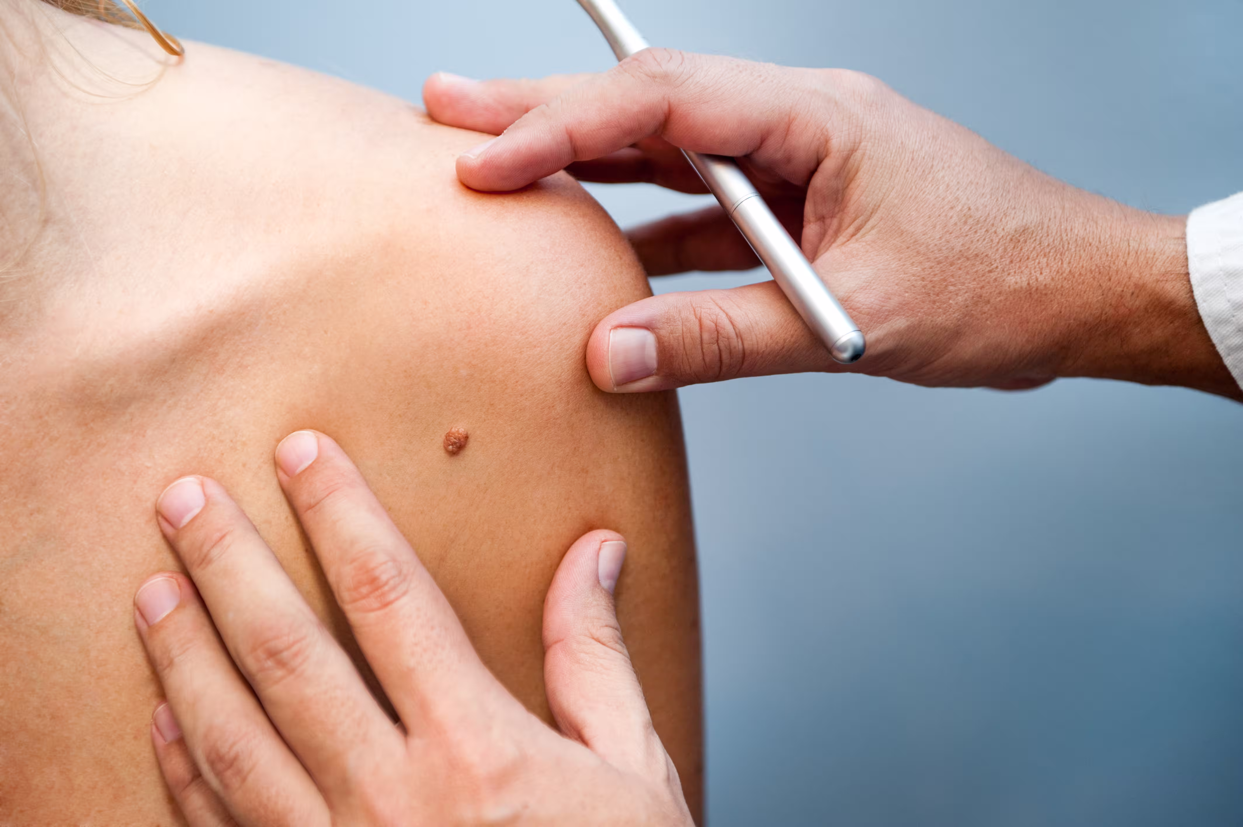 Doctor examining a raised mole on a person's shoulder with a dermatoscope.