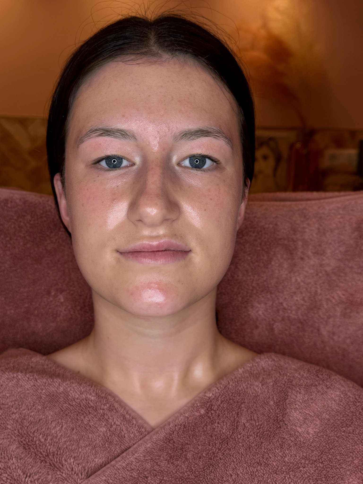 Ruby na haar persoonlijke huidverbeteringstraject van zes maanden
