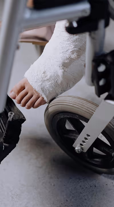 Wheelchair user with foot cast ensures proper healing for ankle fracture in Los Angeles.