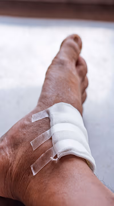 Gauze-covered foot on hospital bed in Los Angeles for neuropathy management, treatment, and preserve mobility.