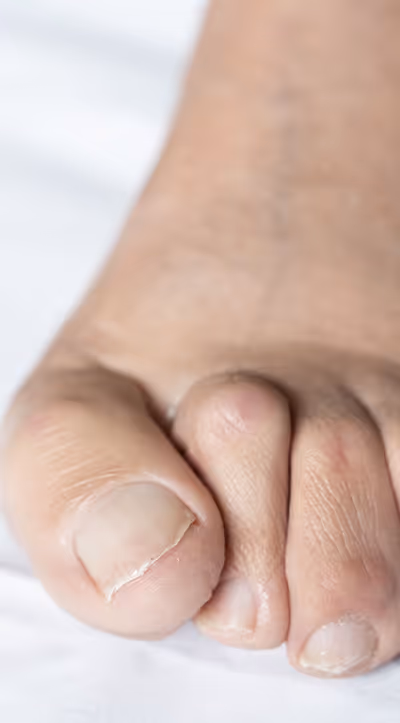 Corrective treatments for curled, painful toes due to hammertoes in Los Angeles, close-up of a foot.