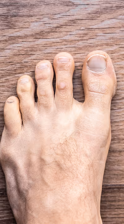 Close-up of a foot with stubborn plantar warts in Los Angeles, highlighting removal options and advanced treatment.