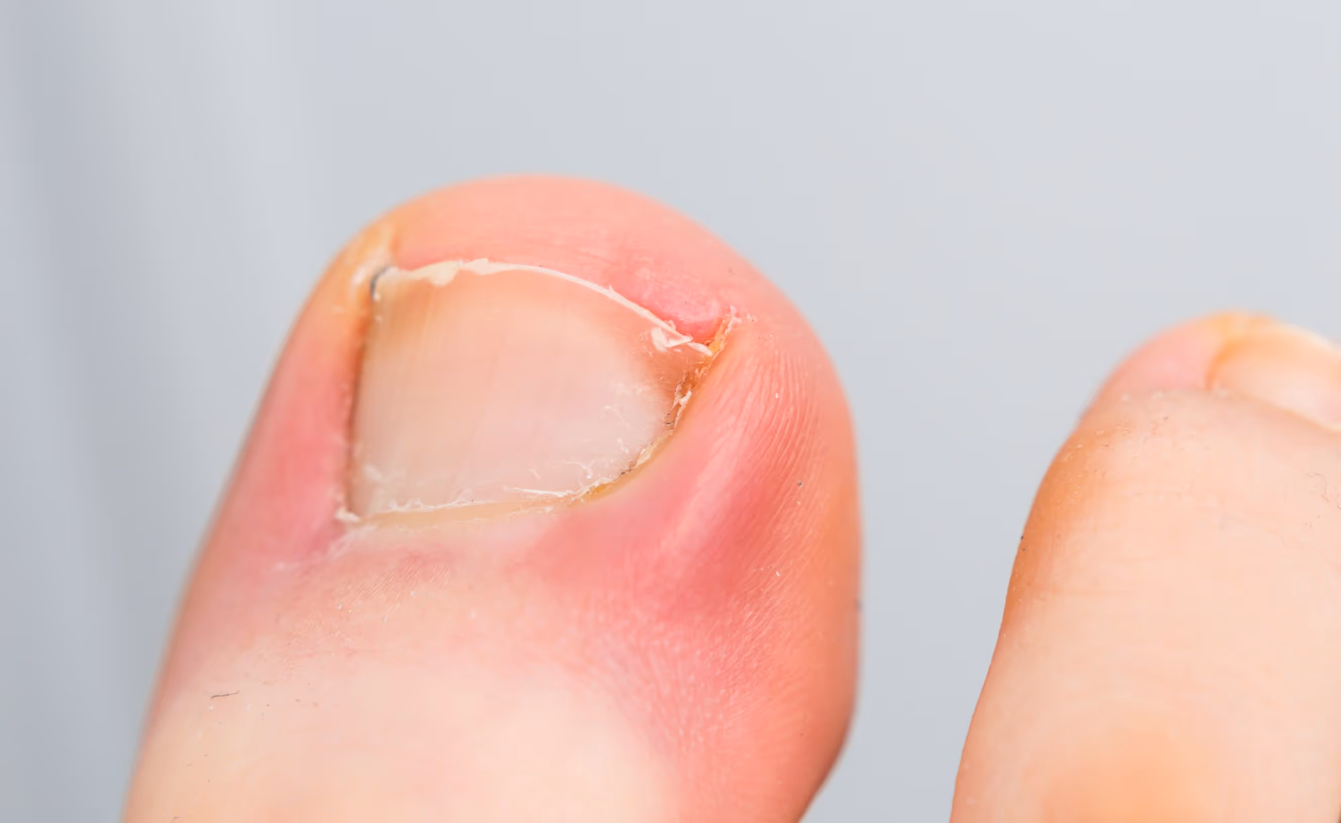Close-up of a toe with ingrown nail symptoms, showing tenderness, redness, sharp pain, and discomfort in Los Angeles.