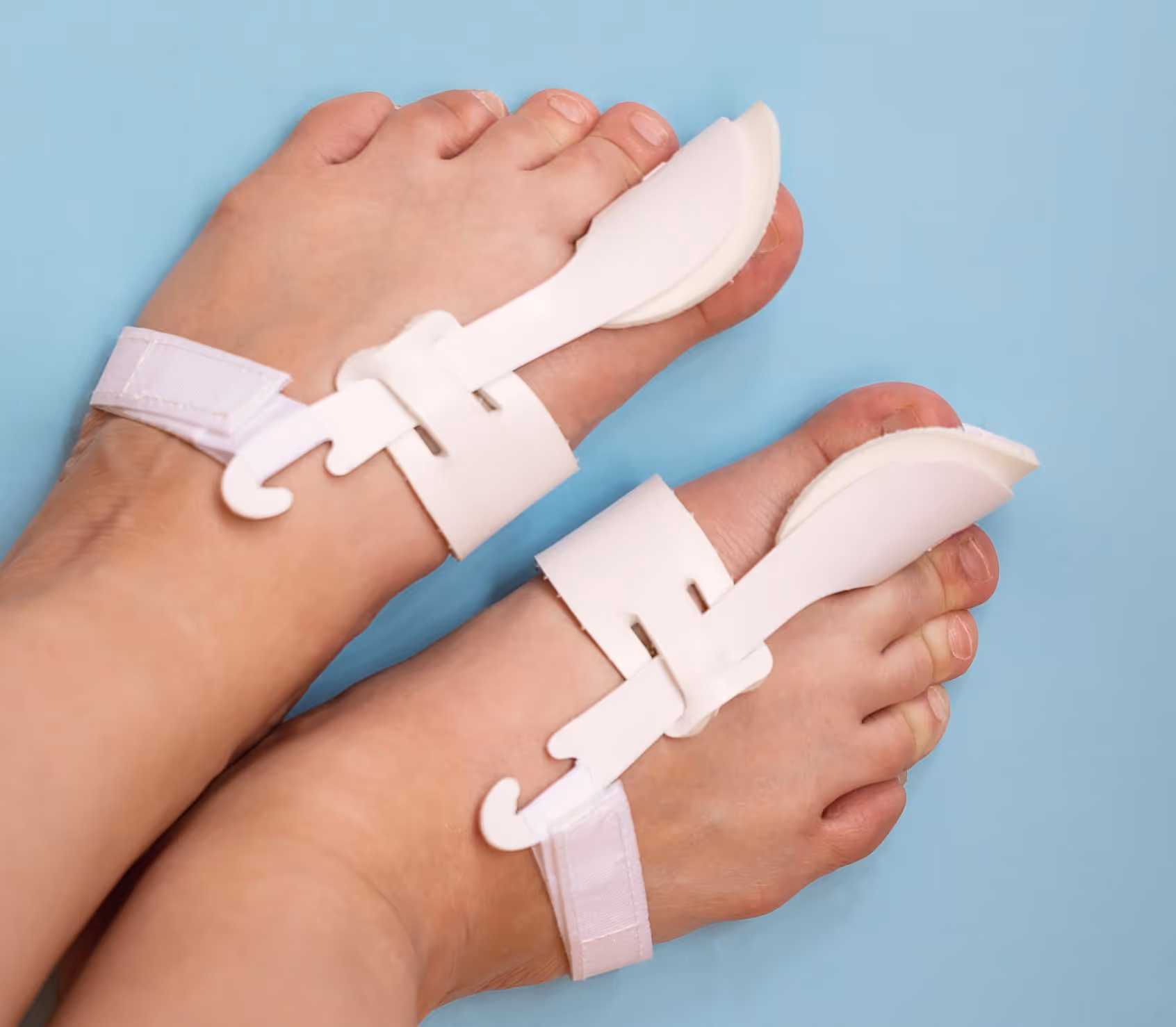 Feet in toe braces for hammertoe in Los Angeles, highlighting conservative care.
