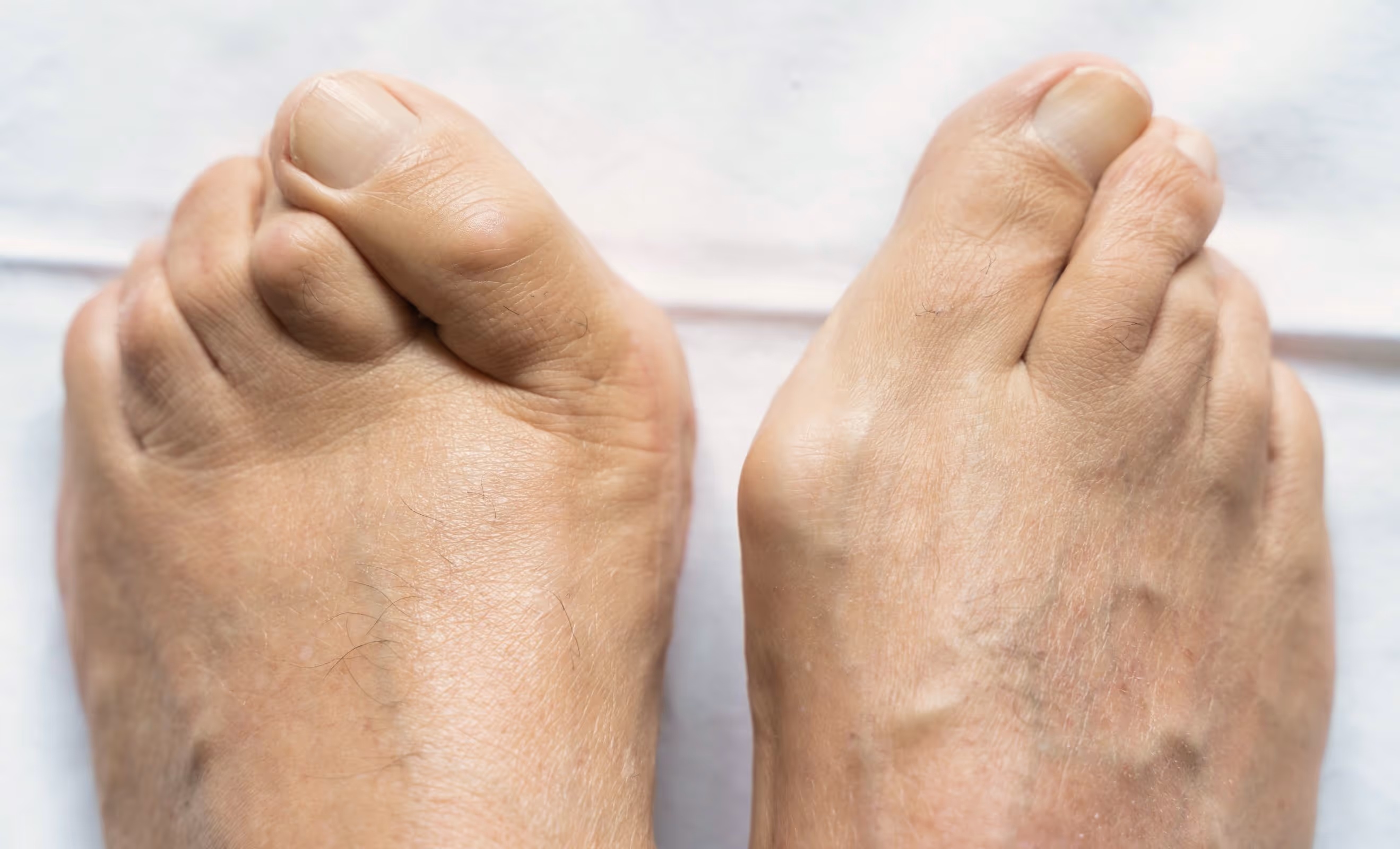 Bent toes with reduced flexibility and difficulty straightening, illustrating hammertoe symptoms in Los Angeles.