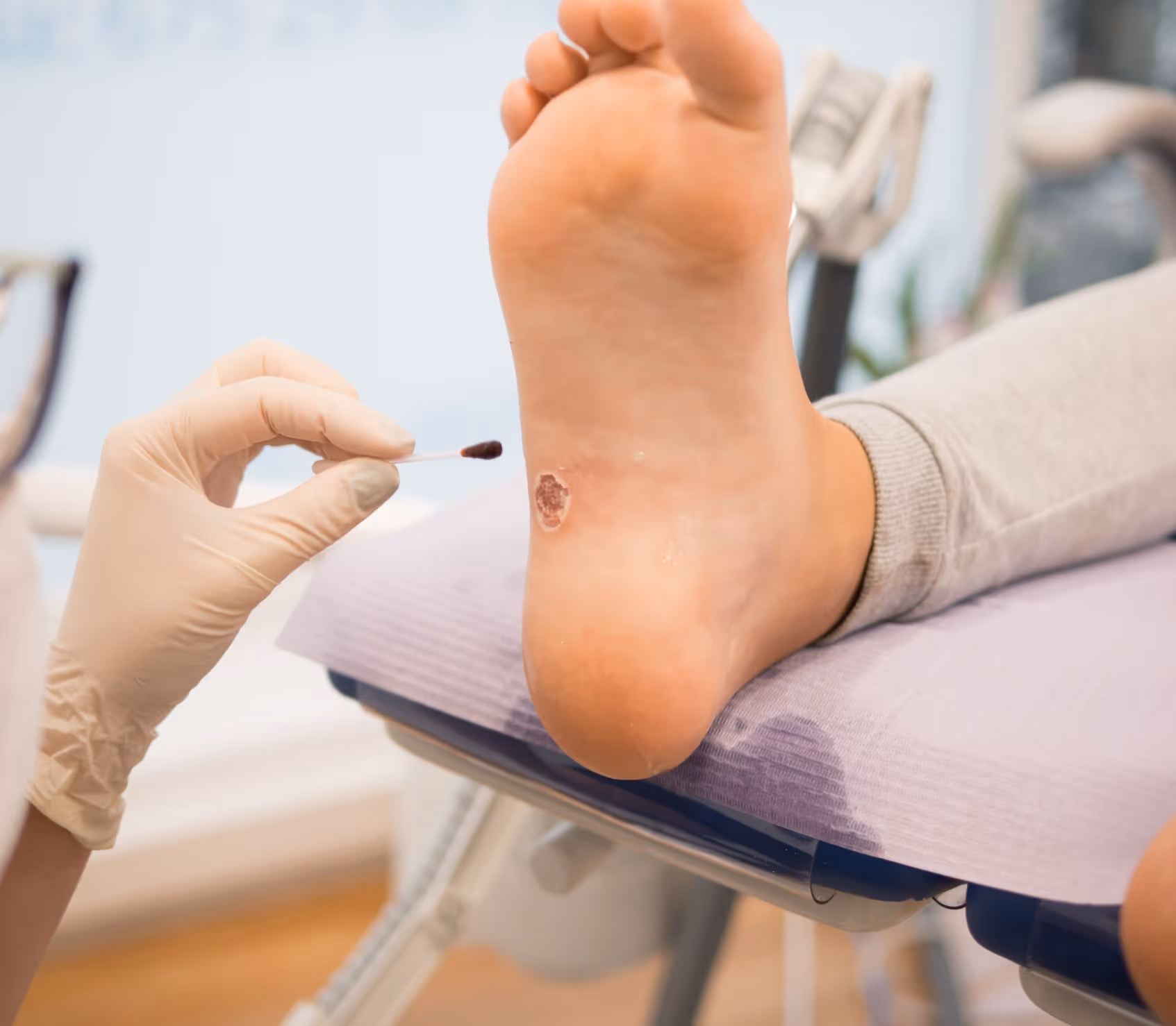 Doctor discusses effective surgical and conservative treatment options for plantar warts in Los Angeles.