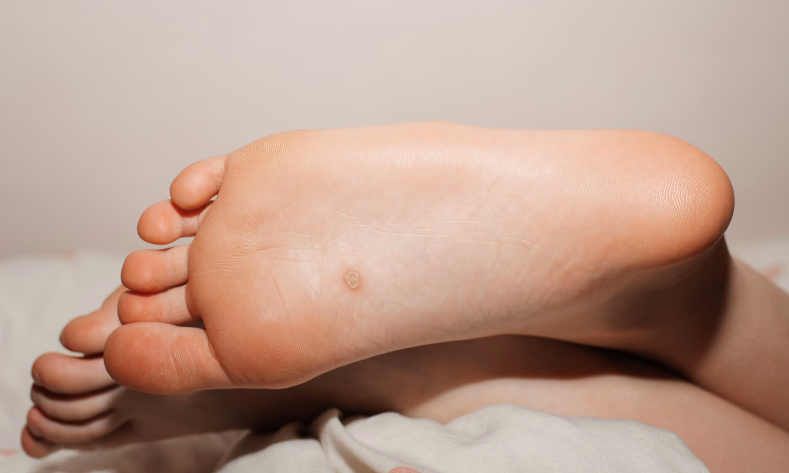 Bare foot on bed with fleshy growths, thickened skin, pain, and tenderness, indicating plantar warts in Los Angeles.