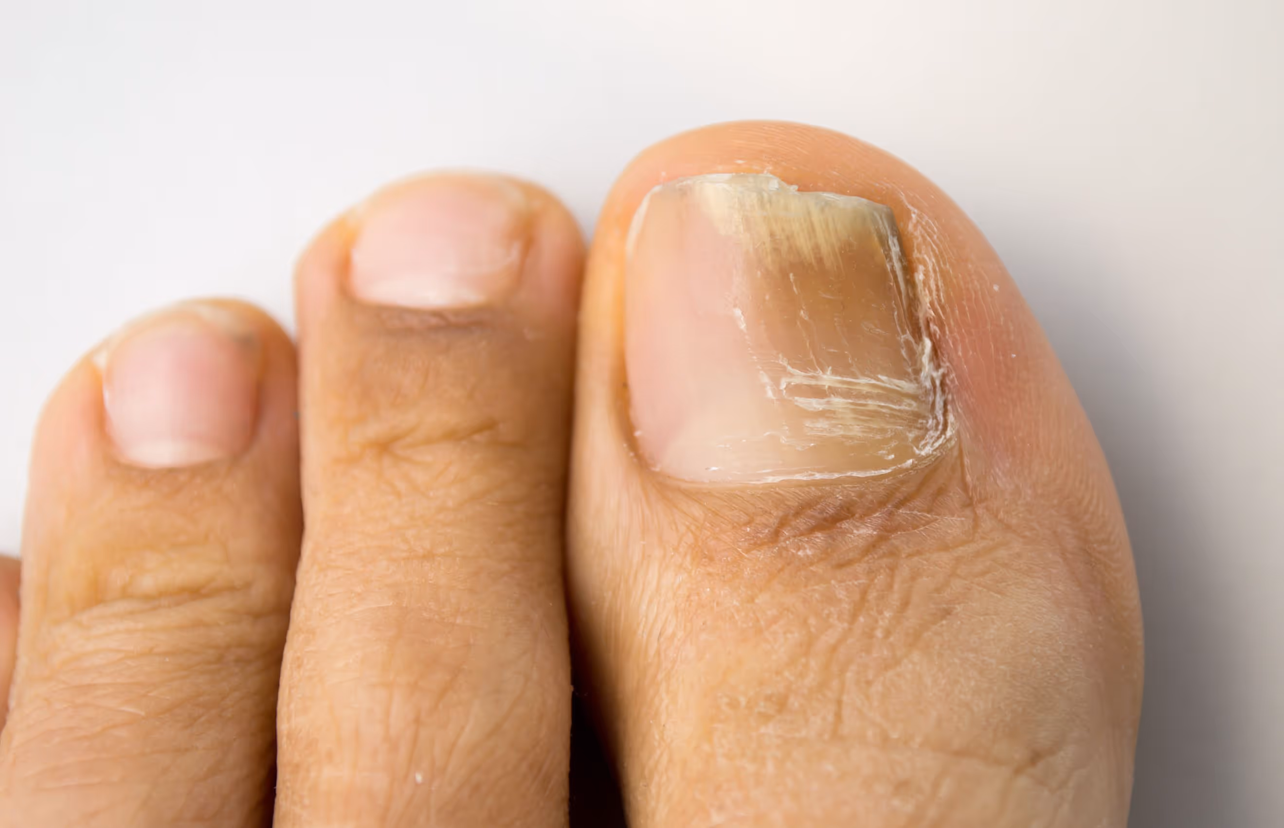 Los Angeles: Thickened nails with discoloration and foul odor, indicating toenail fungus.