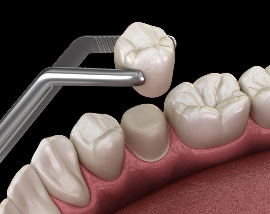 A close-up of teeth and gumsAI-generated content may be incorrect.