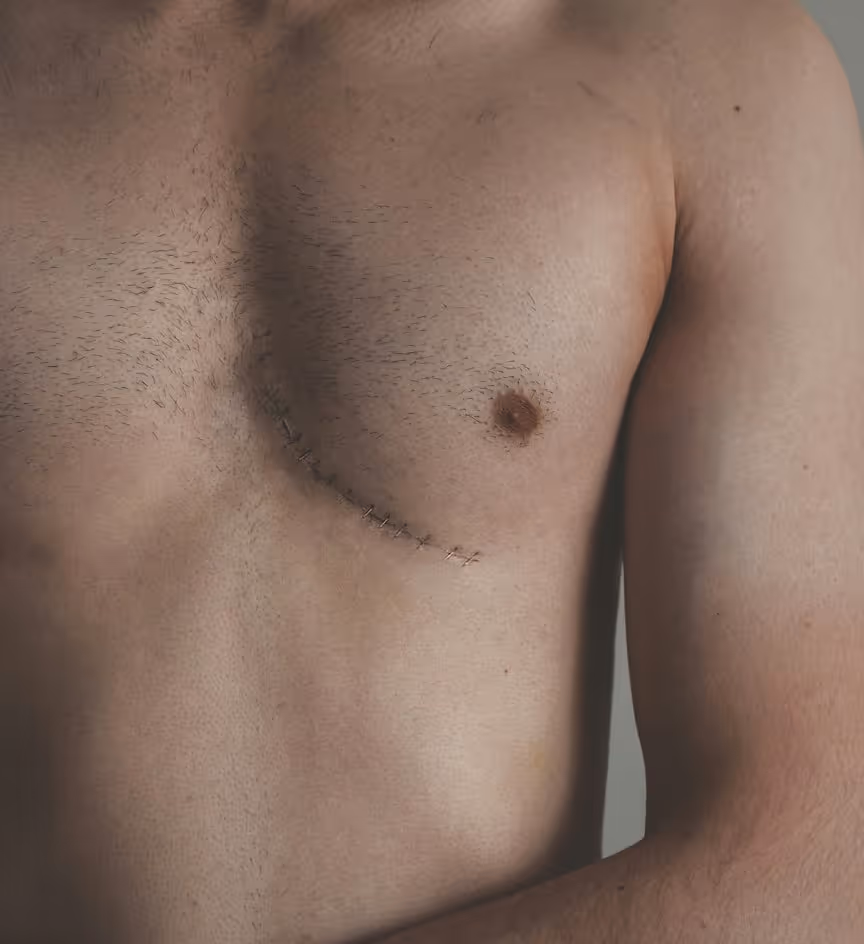 Close-up of a bare male chest with a healing surgical scar and stitches below the left nipple.