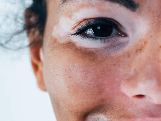 Close-up of a person's face showing a dark eye with patches of lighter skin around it.