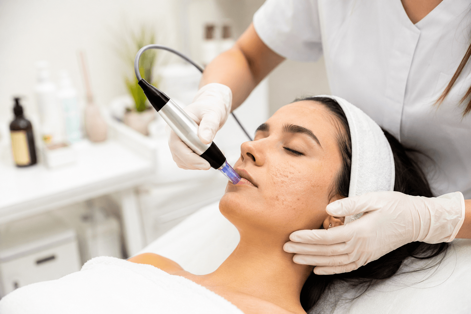 Patient receiving microneedling acne scar treatment at an aesthetic clinic in Ocala, Florida to improve skin texture and reduce acne scarring.