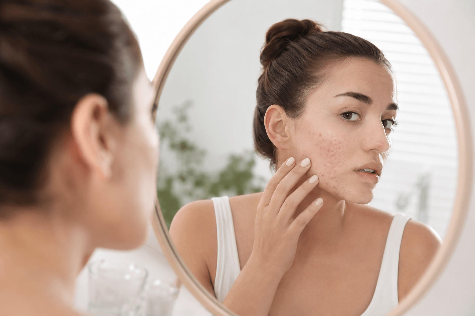 Woman receiving a professional microneedling treatment for acne scars at a medical aesthetics clinic in Ocala, Florida