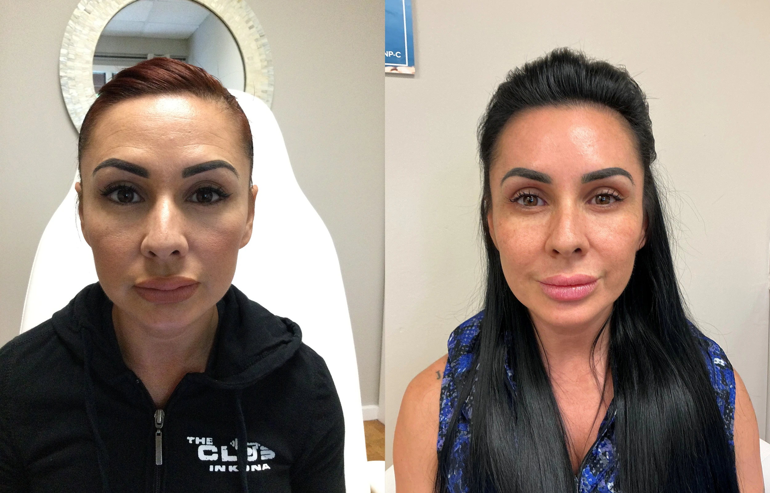 A before and after image of a client of Natural Results Medical Aesthetics