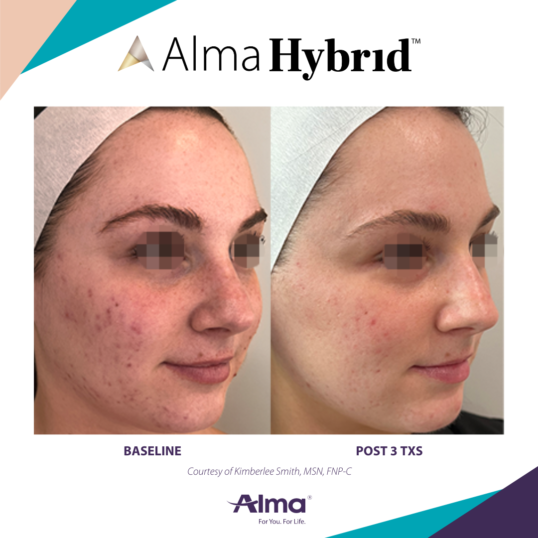 Side-by-side comparison of a woman's face showing significant acne before treatment on the left and clearer skin with reduced acne after three Alma Hybrid treatments on the right.