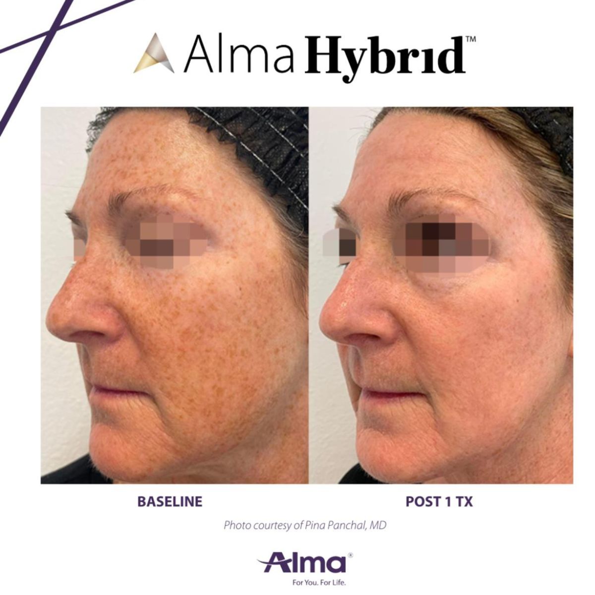 Side-by-side comparison of a woman's face before and after one Alma Hybrid treatment showing reduced facial pigmentation and improved skin tone.