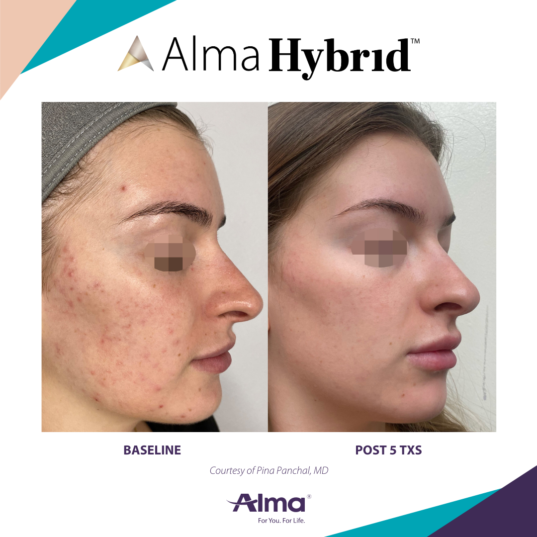 Side-by-side comparison of a woman's face showing acne on baseline left and clearer skin post 5 treatments on right under Alma Hybrid skincare.