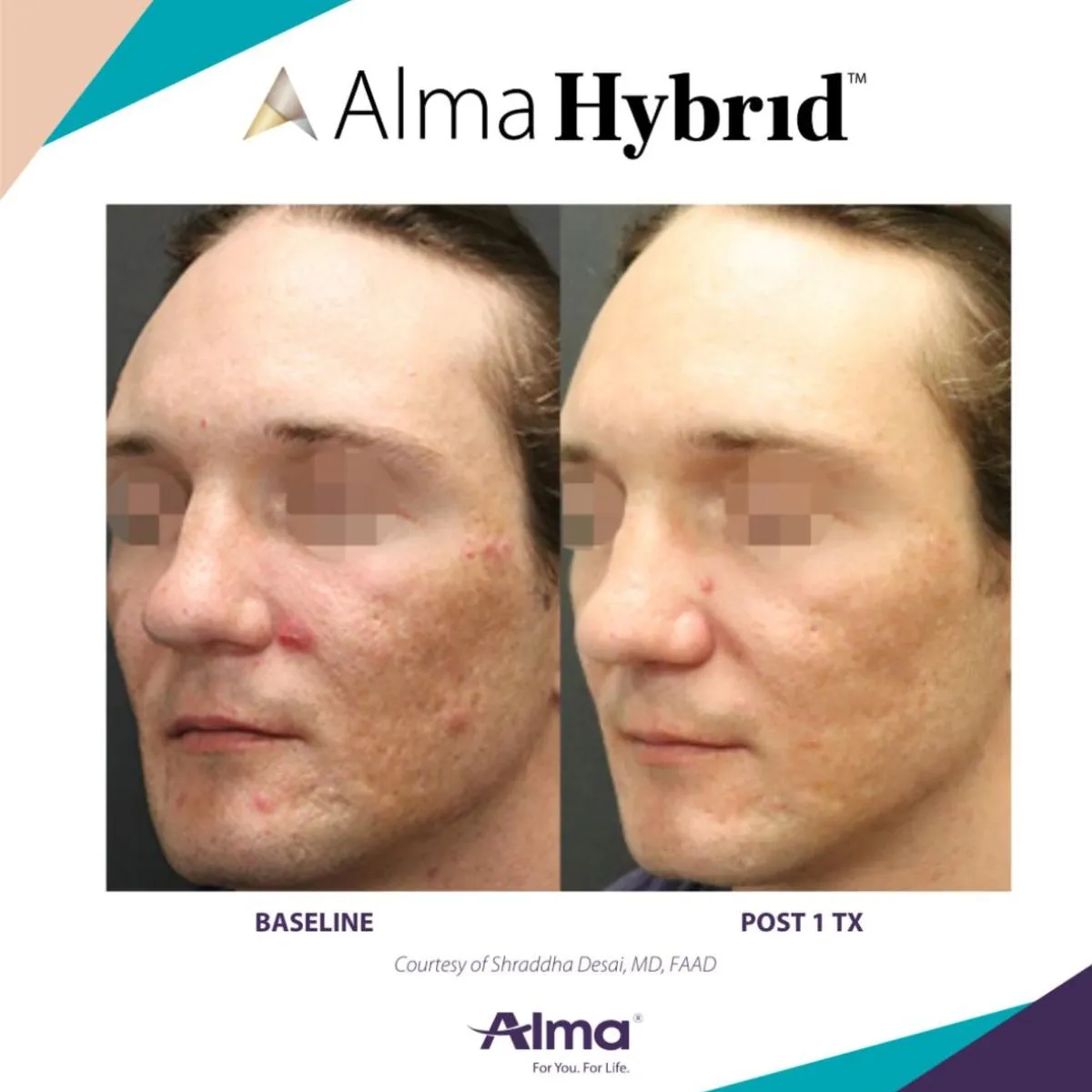 Side-by-side comparison of a man's face showing acne scars and redness at baseline and improved skin texture and less redness post treatment.