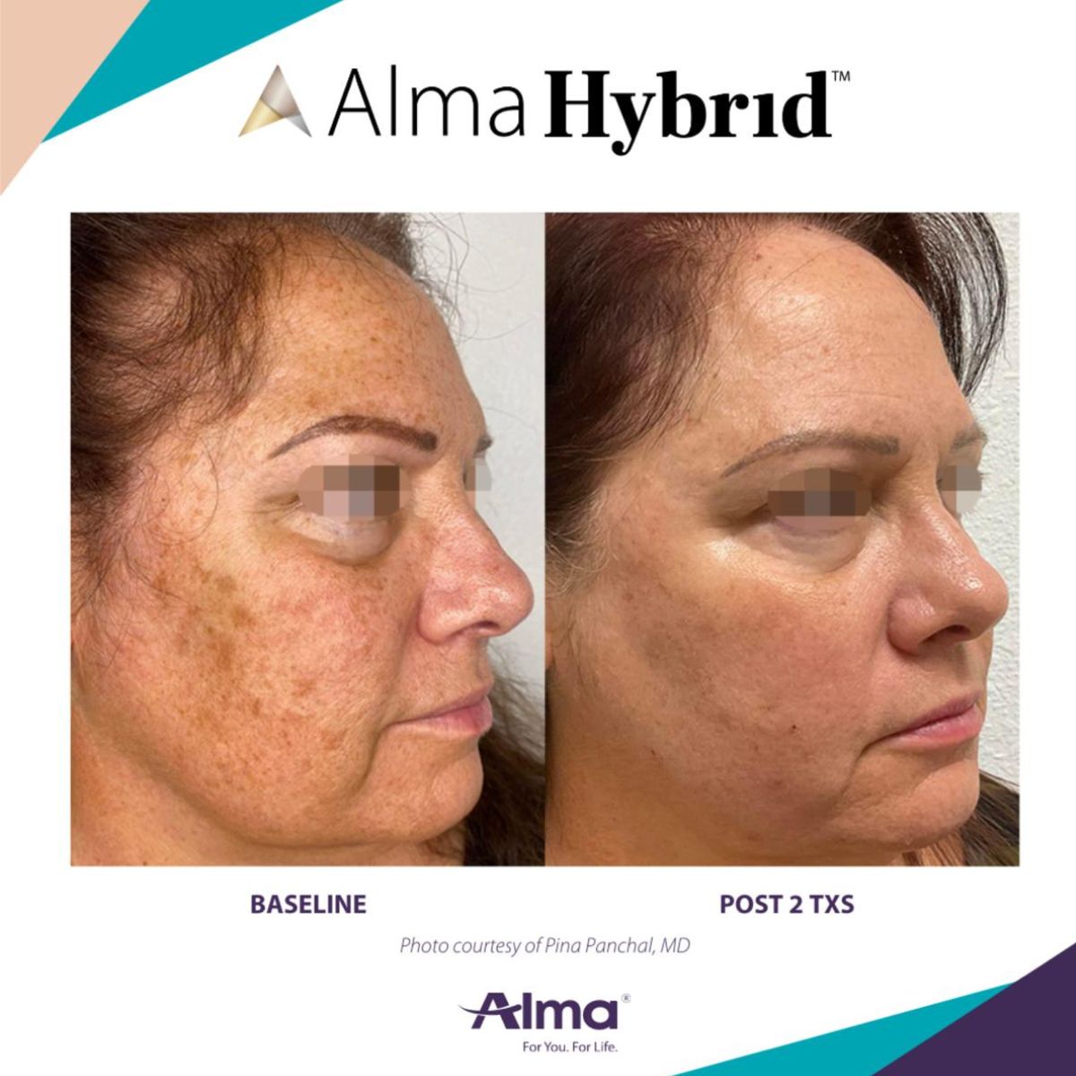 Side-by-side comparison of a woman's face before and after two treatments, showing significant reduction in skin pigmentation and improved complexion.