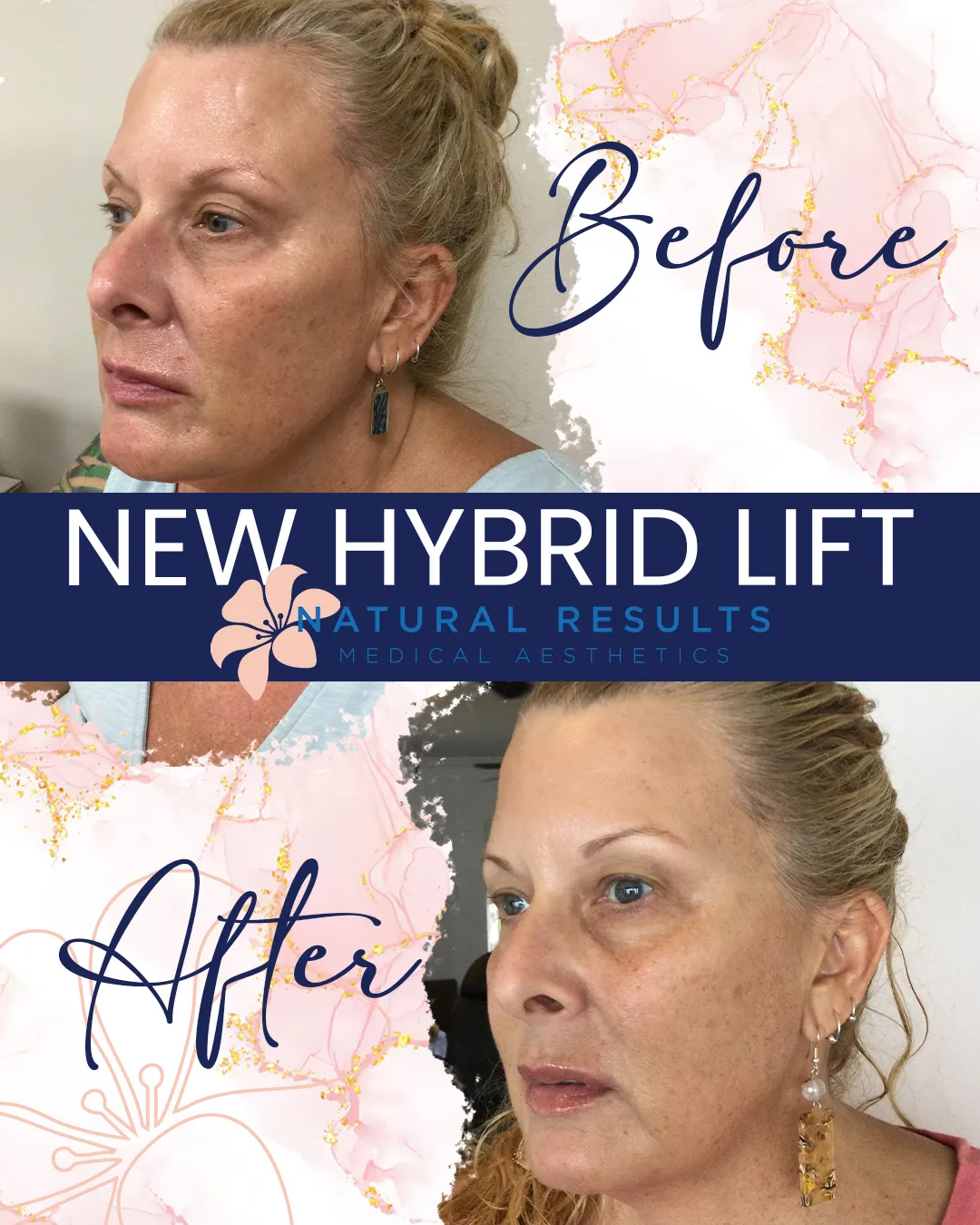 Side-by-side before and after images of a woman showing facial improvements from a new hybrid lift treatment by Natural Results Medical Aesthetics.