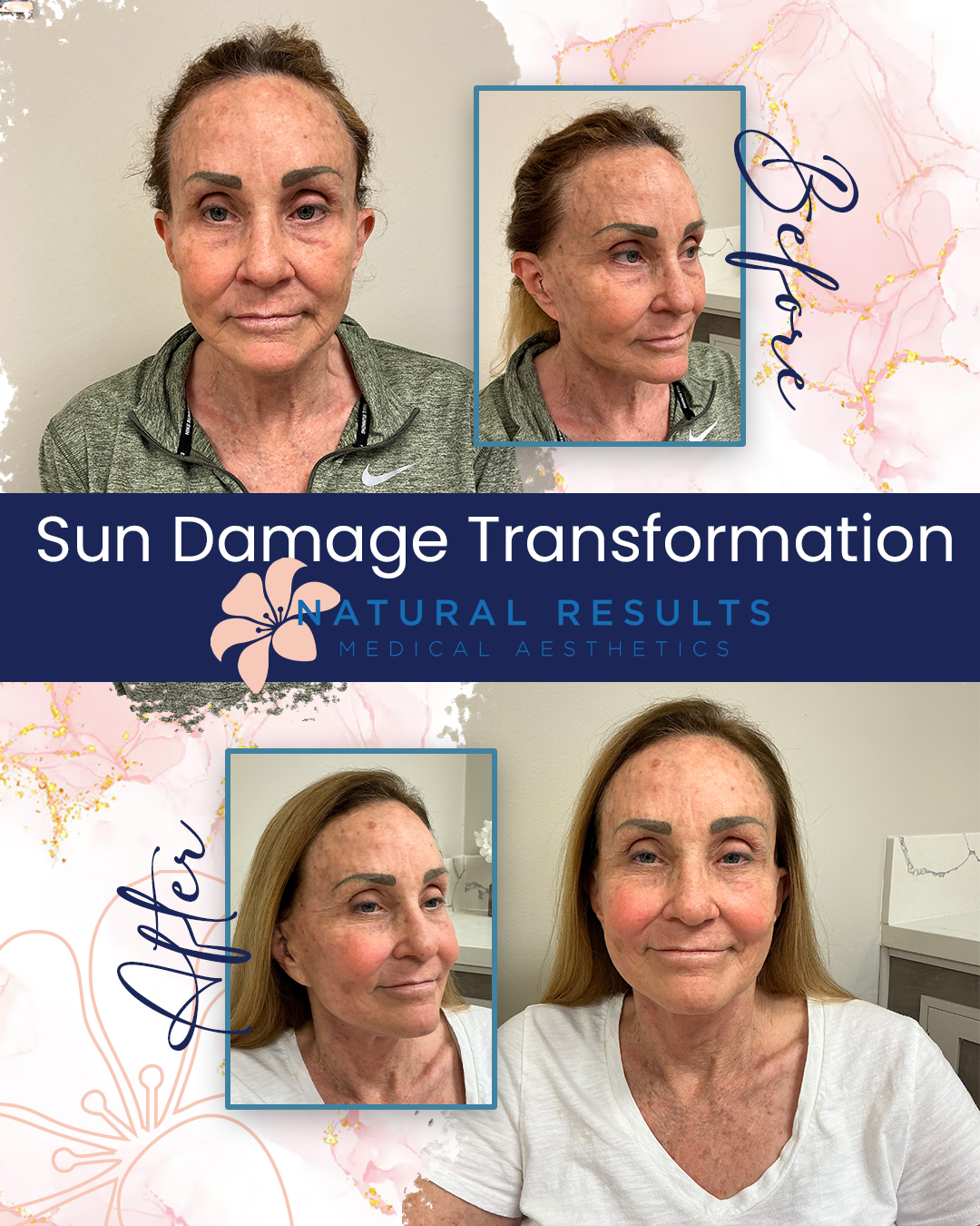 Before and after photos of a woman's face showing sun damage transformation with improved skin tone and texture, associated with Natural Results Medical Aesthetics.