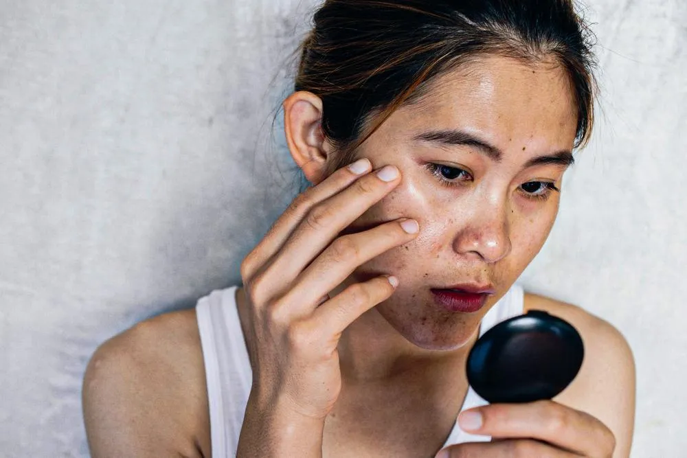 Hậu quả tắm trắng phi thuyền sai cách có thể khiến da bong tróc, sạm đen và tổn thương nghiêm trọng.