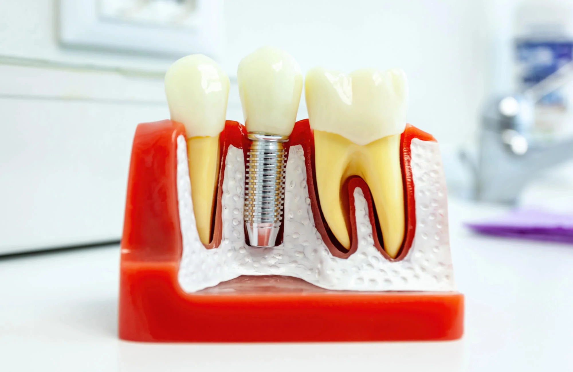 Close-up of a model for dental implants in Easton, PA