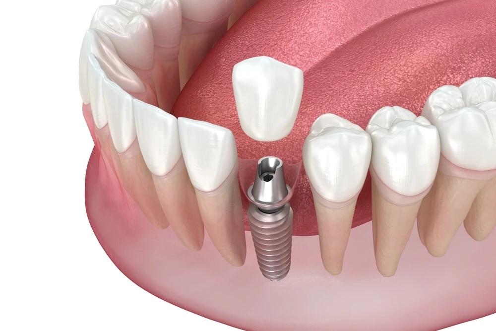 Dental Implants in Somerton