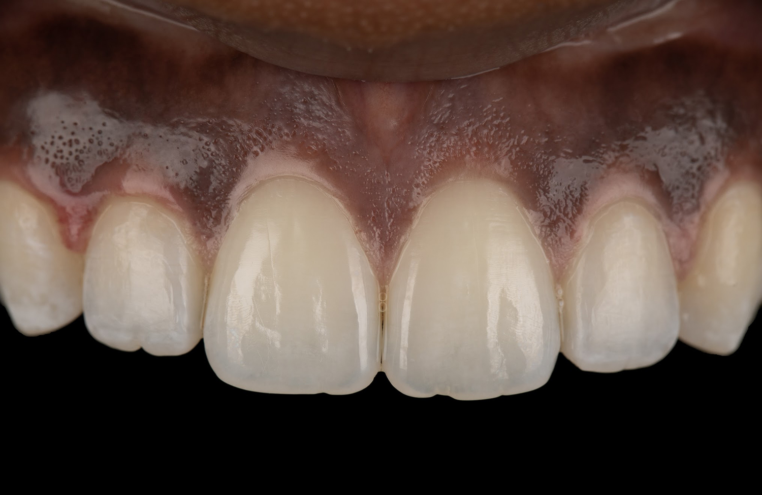 Close-up of healthy upper front teeth and gums with natural texture and color.