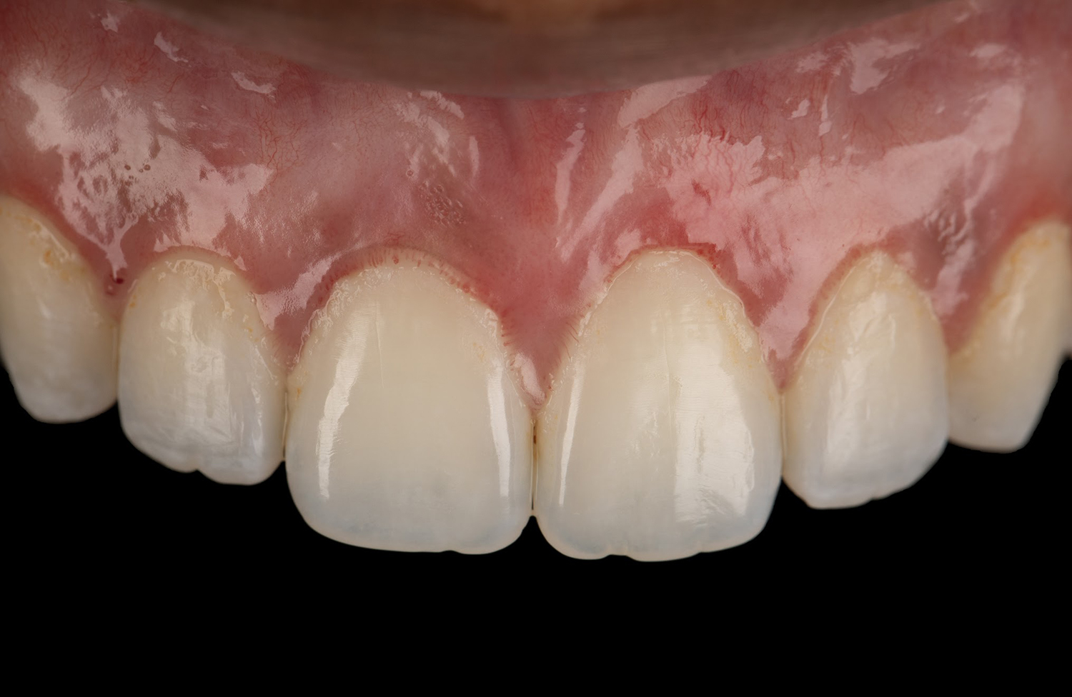 Close-up of healthy upper front teeth and pink gums on a black background.