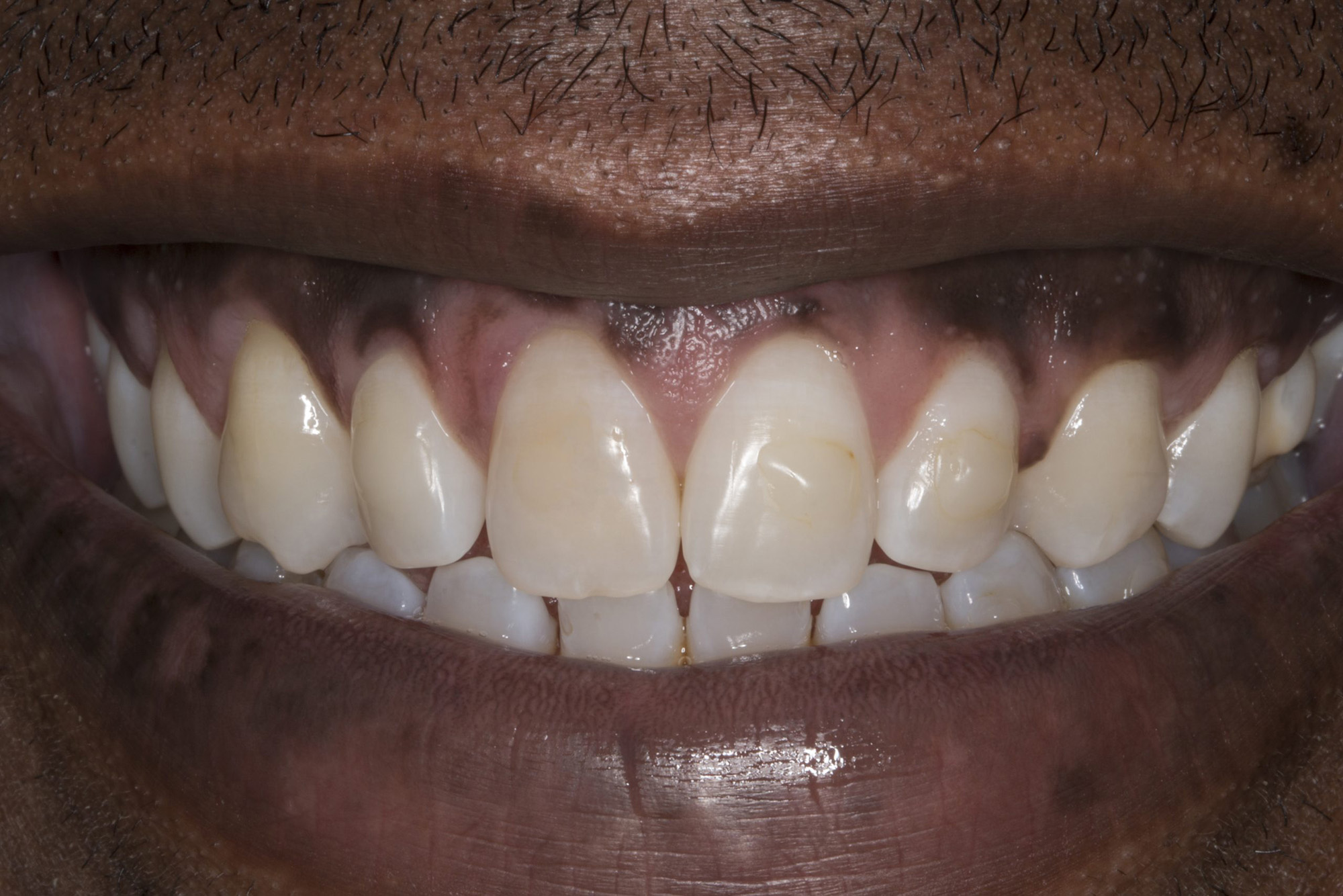 Close-up of a smiling mouth showing upper and lower teeth with natural discoloration and gaps.